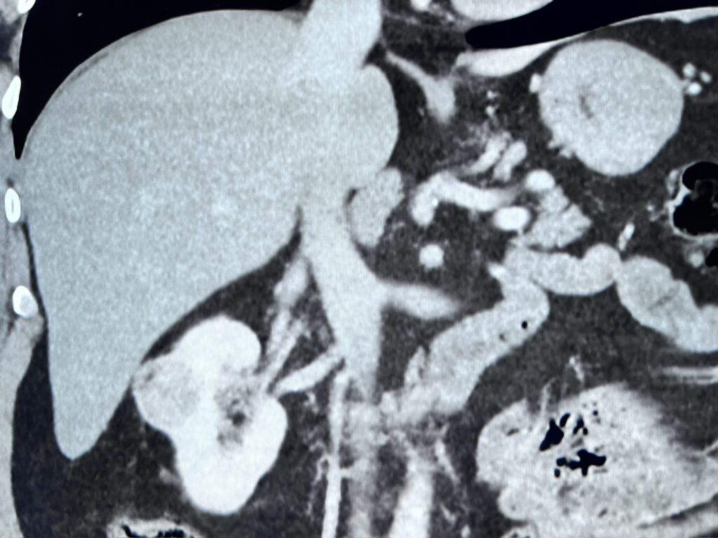 Tomografia computadorizada do abdome em corte coronal, com visualização dos rins